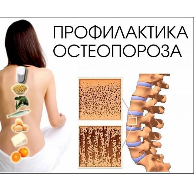Остеопороз &ndash; это заболевание
