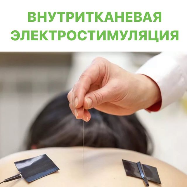 ВНУТРИТКАНЕВАЯ ЭЛЕКТРОСТИМУЛЯЦИЯ проводится игольчатым электродом