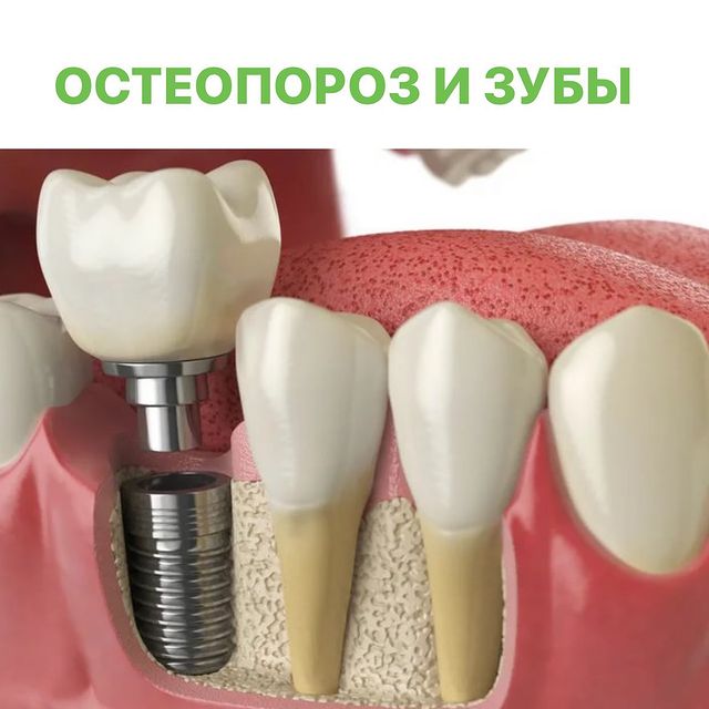 ОСТЕОПОРОЗ &ndash; обменное заболевание костной ткани