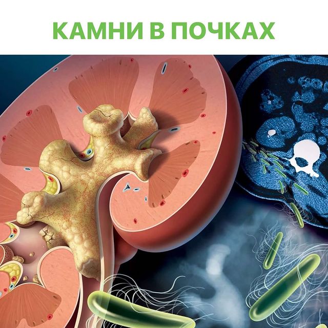 КАМНИ В ПОЧКАХ.