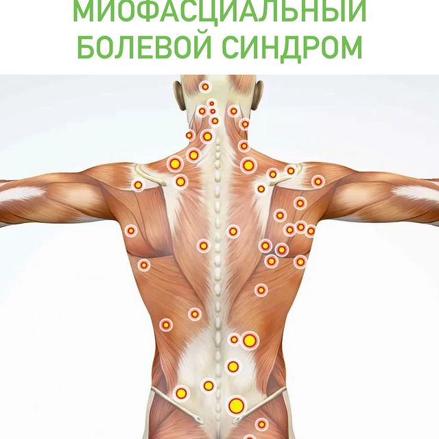 Миофасциальный болевой синдром.