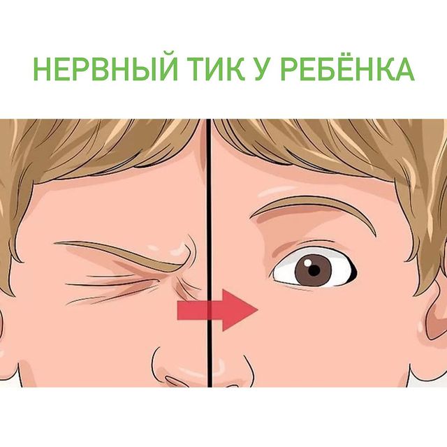 Тики у детей &ndash; внезапные повторяющиеся движения