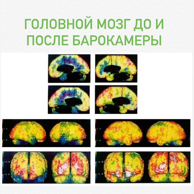 КАК БАРОКАМЕРА ВЛИЯЕТ НА КРОВОСНАБЖЕНИЕ ГОЛОВНОГО МОЗГА.