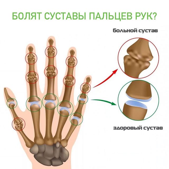 Болят суставы пальцев рук?