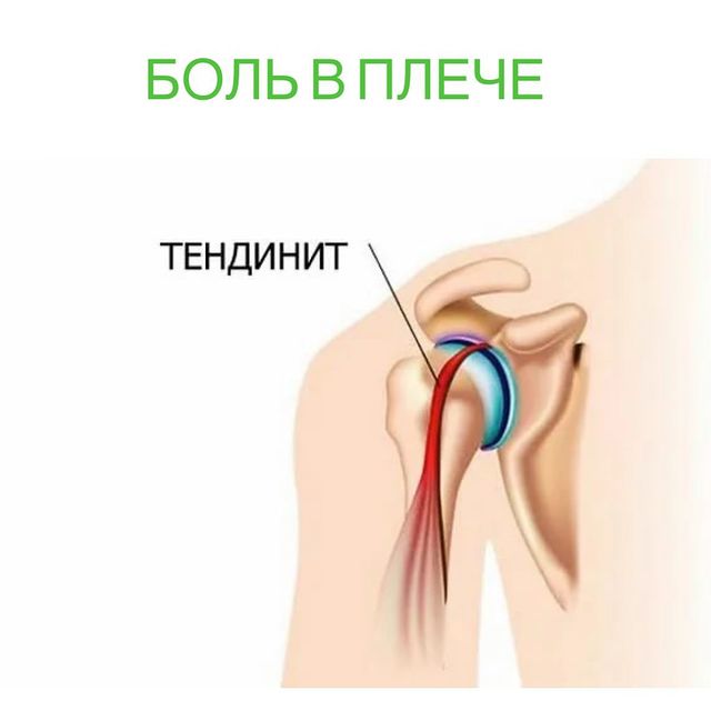 Боль в плече. что делать?